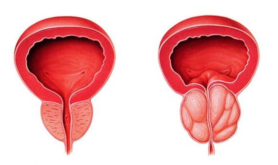 Prostatako normala eta hanturatua (prostatitisa)