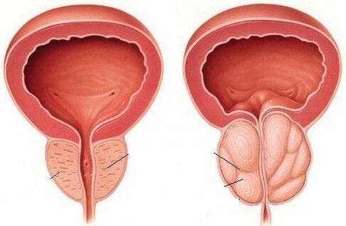 prostatitis kronikoa duen prostata osasuntsu eta hanturatua